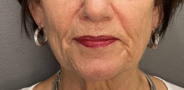 After Image: Profound Matrix Pro RF Microneedling - front