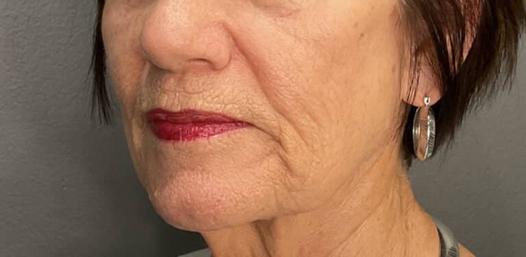 After Image: Profound Matrix Pro RF Microneedling - left-front-oblique