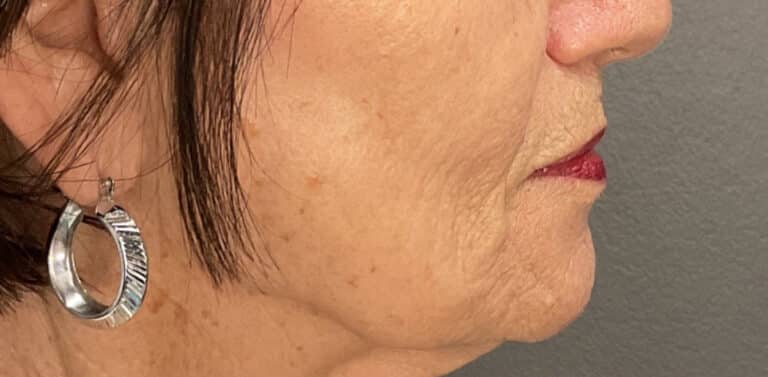 After Image: Profound Matrix Pro RF Microneedling - right-side