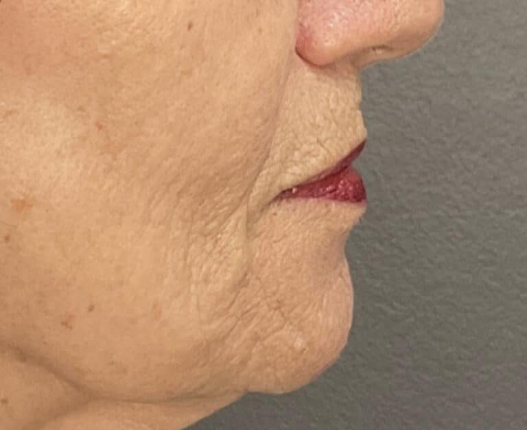 After Image: Profound Matrix Pro RF Microneedling - right-side