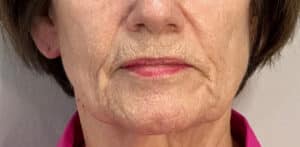 Before Image: Profound Matrix Pro RF Microneedling