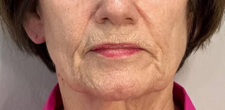 Before Image: Profound Matrix Pro RF Microneedling - front