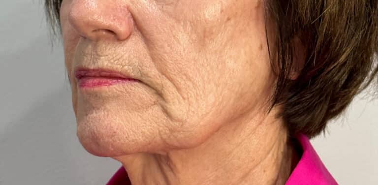 Before Image: Profound Matrix Pro RF Microneedling - left-front-oblique