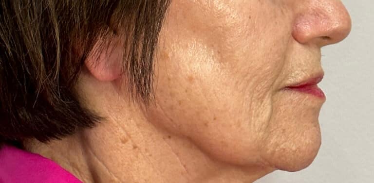 Before Image: Profound Matrix Pro RF Microneedling - right-side