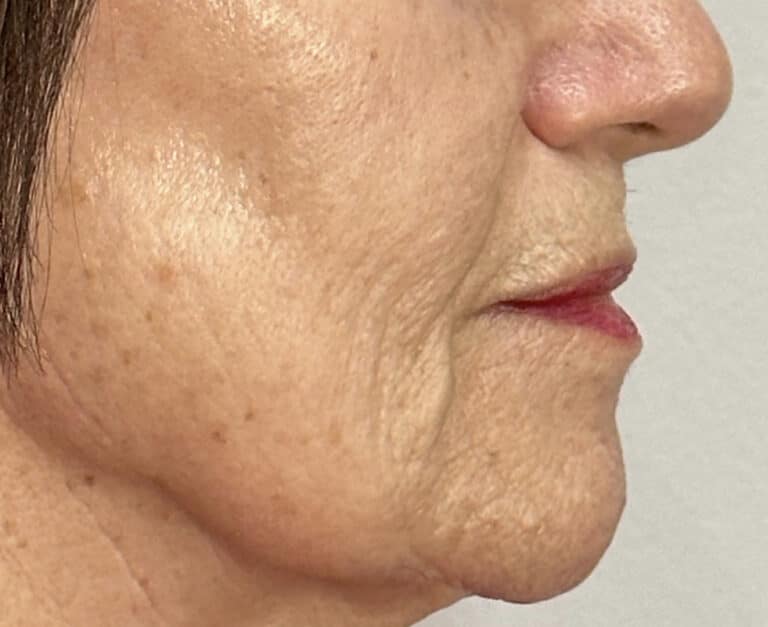 Before Image: Profound Matrix Pro RF Microneedling - right-side