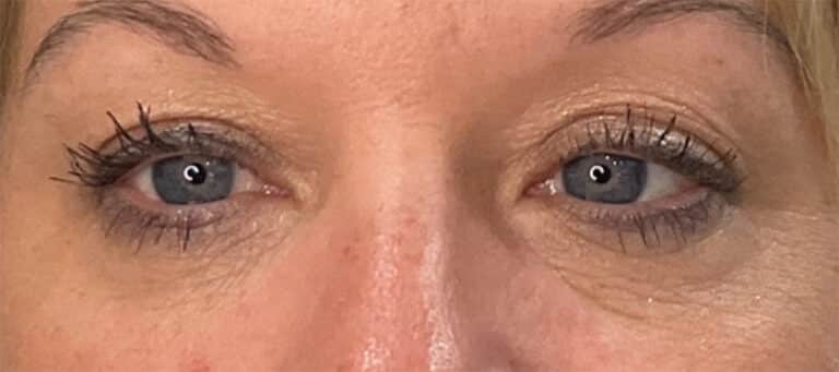 After Image: EyeMax eye cream + Jeuveau under eyes - front