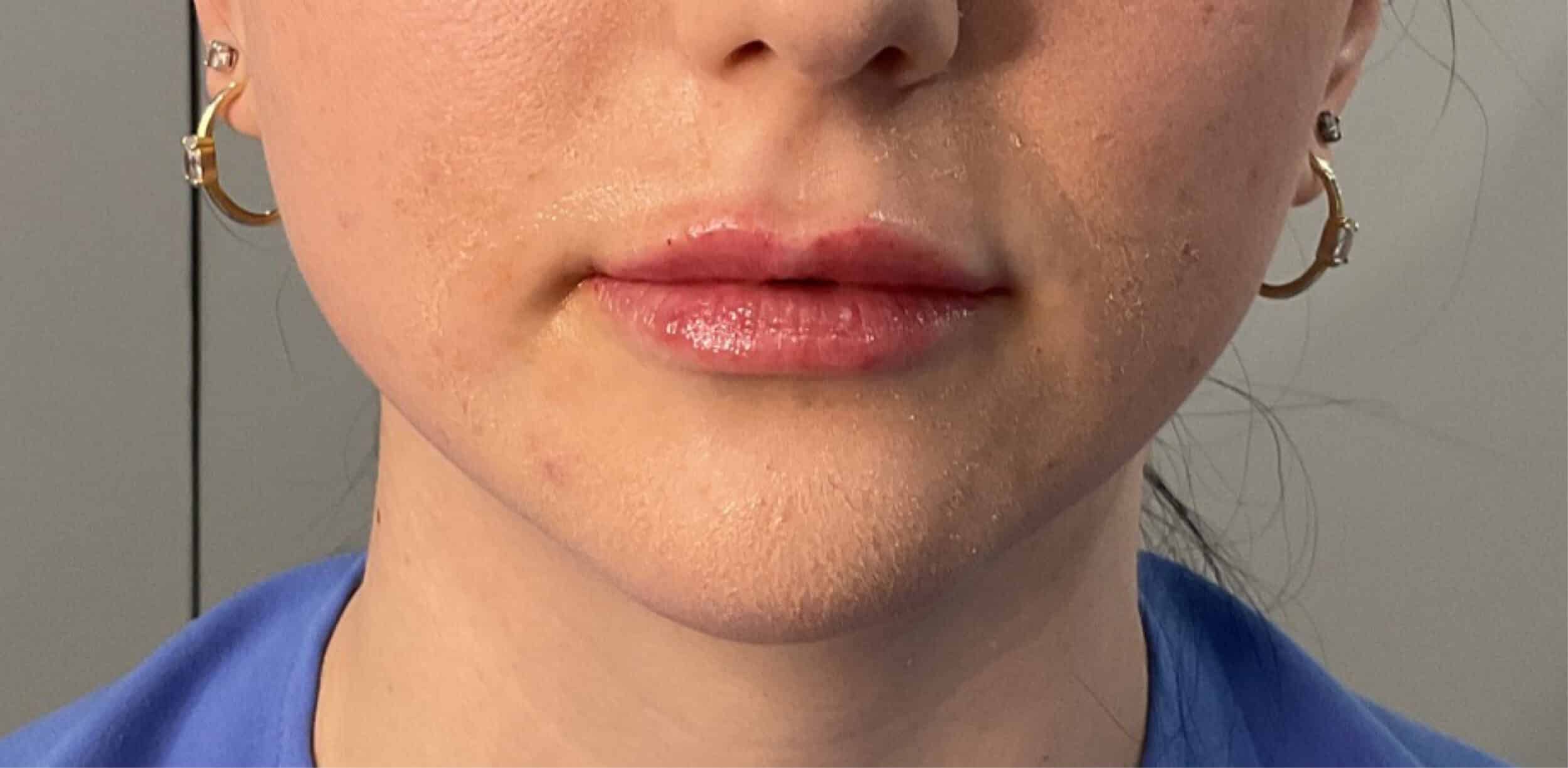 After Image: Lip Filler - front