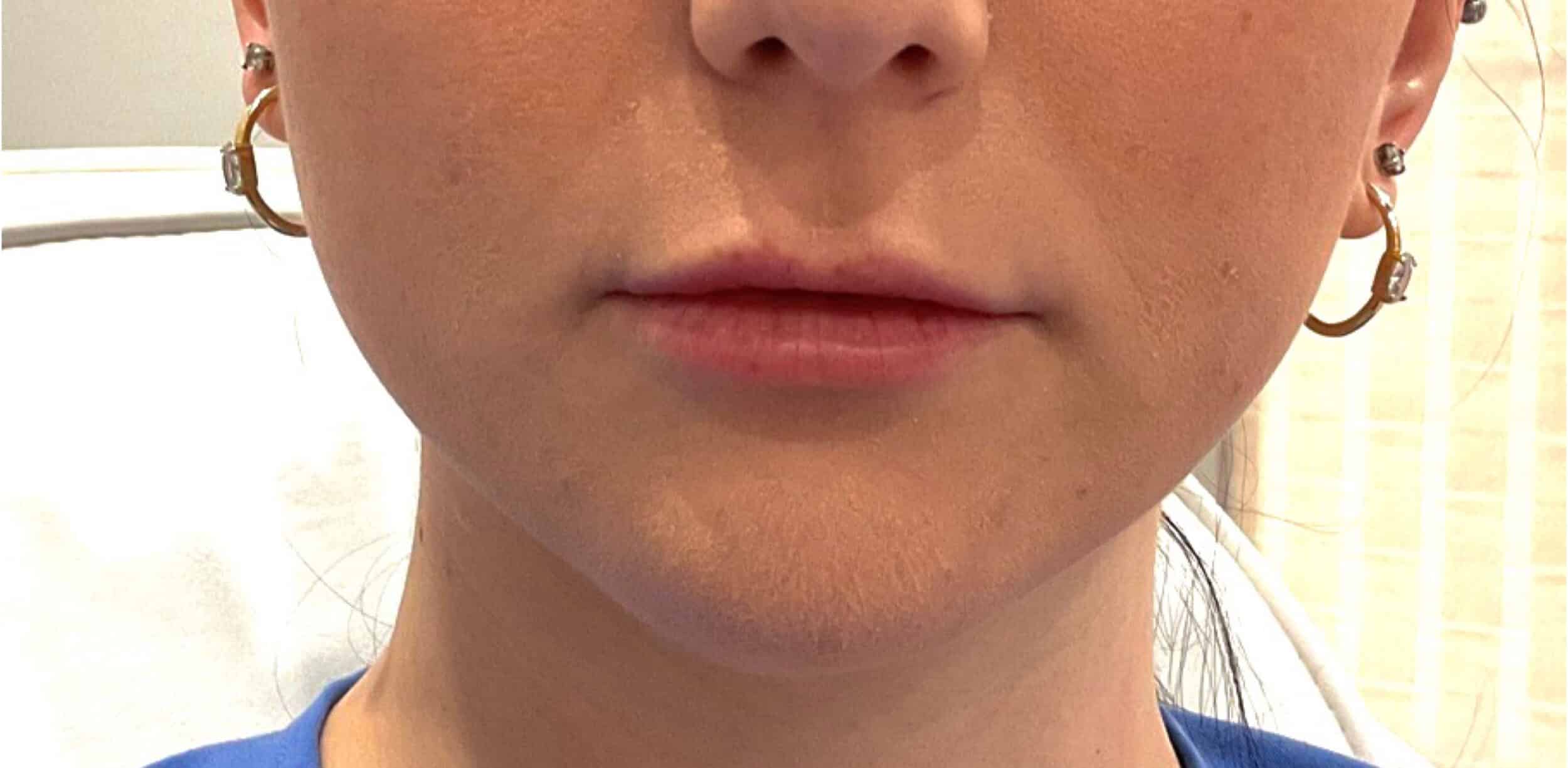 Before Image: Lip Filler - front
