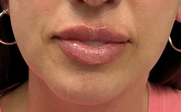 After Image: Lip Filler - front