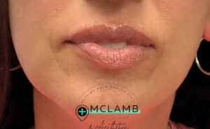 Before Image: Lip Filler