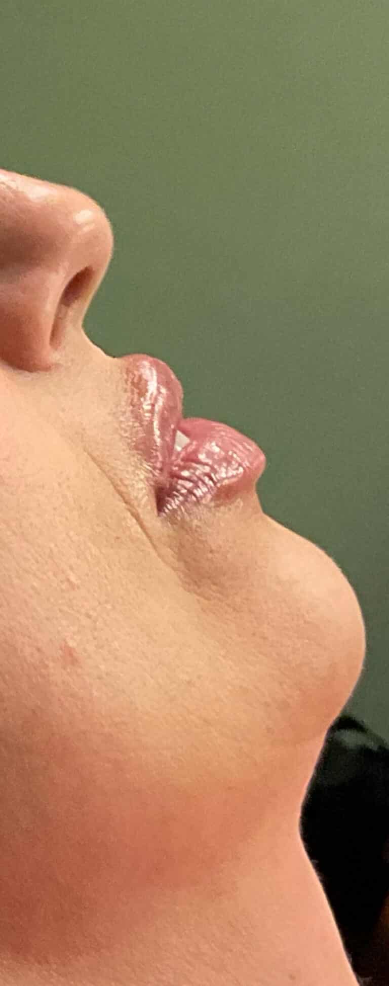 After Image: Lip Filler - right-front-oblique