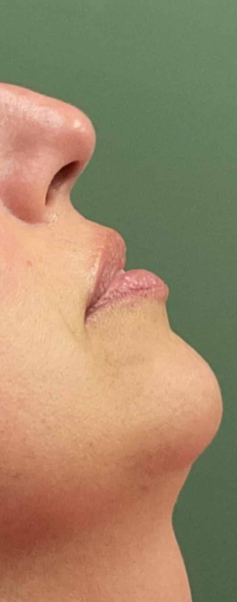 Before Image: Lip Filler - right-front-oblique