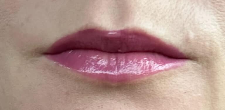 After Image: Lip Flip with Neurotoxins - front