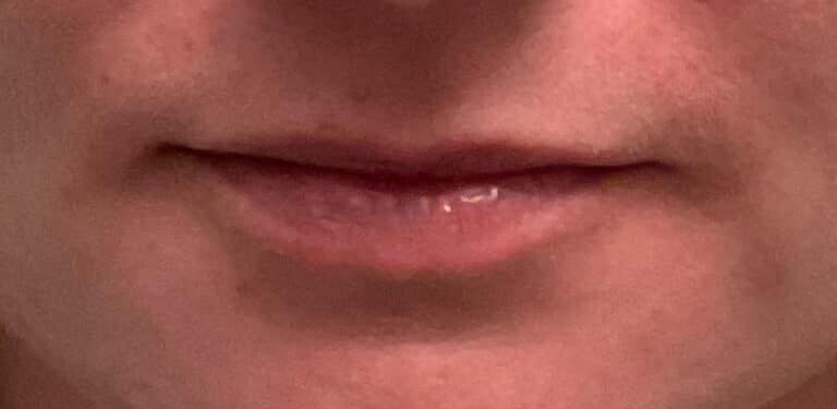 Before Image: Lip Flip with Neurotoxins - front