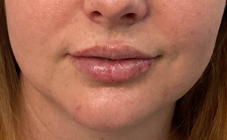 After Image: Lips and Chin Filler - front