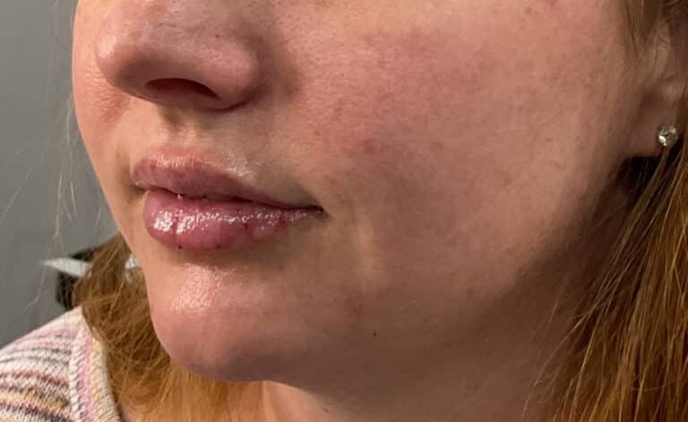 After Image: Lips and Chin Filler - left-front-oblique