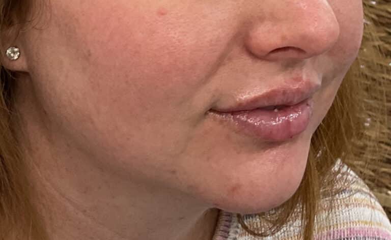 After Image: Lips and Chin Filler - right-front-oblique