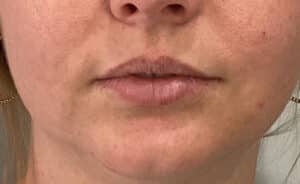 Before Image: Lips and Chin Filler