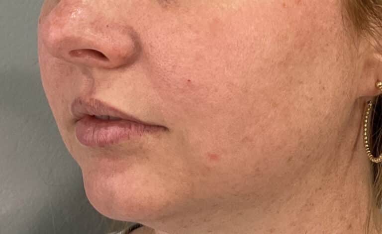 Before Image: Lips and Chin Filler - left-front-oblique