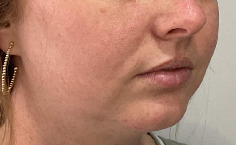 Before Image: Lips and Chin Filler - right-front-oblique