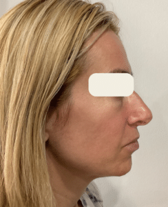 Before Image: Sculptra