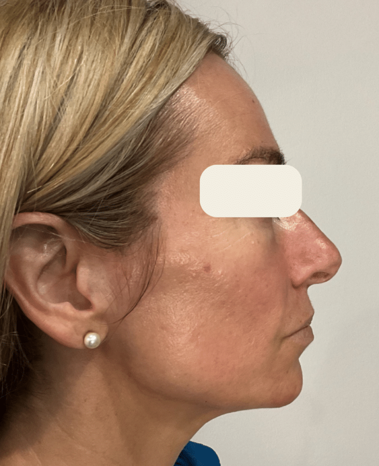 After Image: Sculptra - right-side