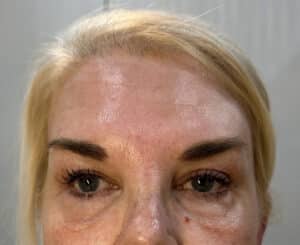 After Image: 4 weeks after 1 Matrix Pro treatment