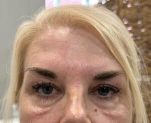 Before Image: 4 weeks after 1 Matrix Pro treatment