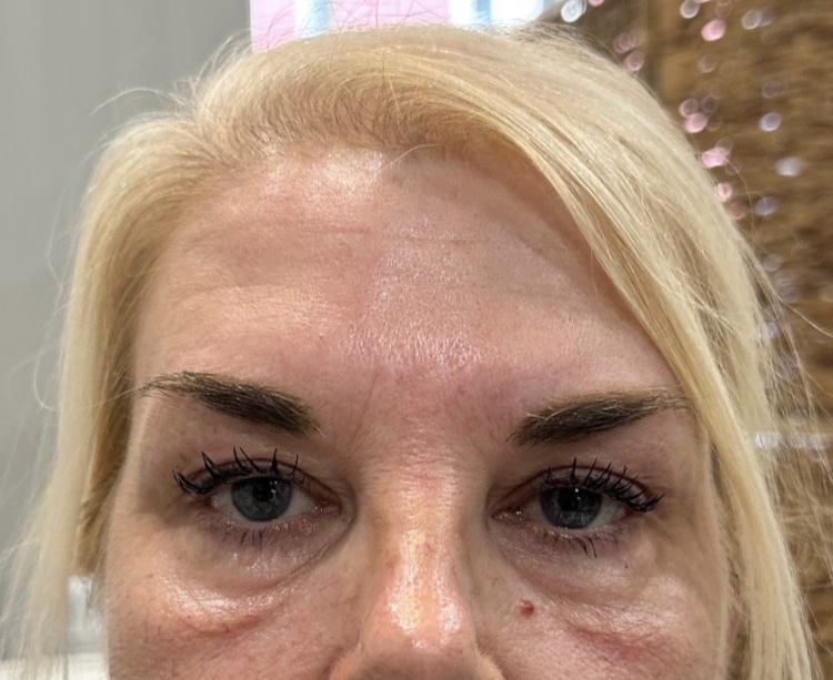 Before Image: 4 weeks after 1 Matrix Pro treatment - front