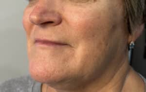 After Image: 8 weeks after 1 treatment of Sculptra