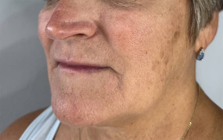 Before Image: 8 weeks after 1 treatment of Sculptra - left-front-oblique