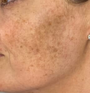 Before Image: IPL for Sun-Damage / Dark Spots