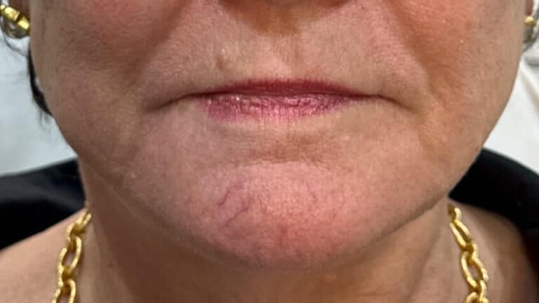 Before Image: IPL for Telangiectasias - front