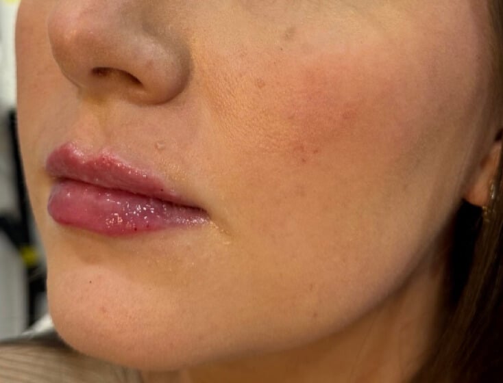 After Image: Lip Filler - left-front-oblique