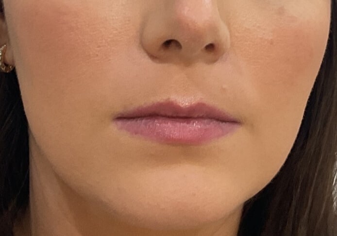 Before Image: Lip Filler - front