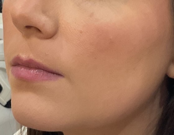 Before Image: Lip Filler - left-front-oblique