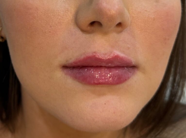 After Image: Lip Filler - front