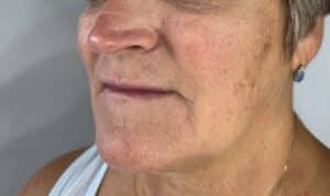 Before Image: Sculptra