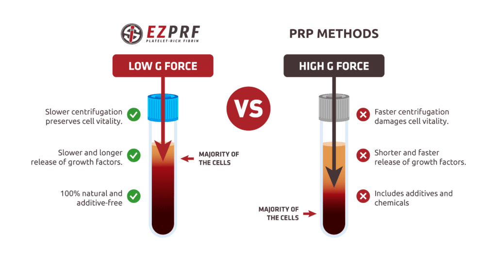 PRF vs PRP