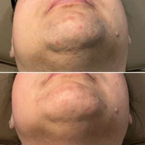 PCOS LHR