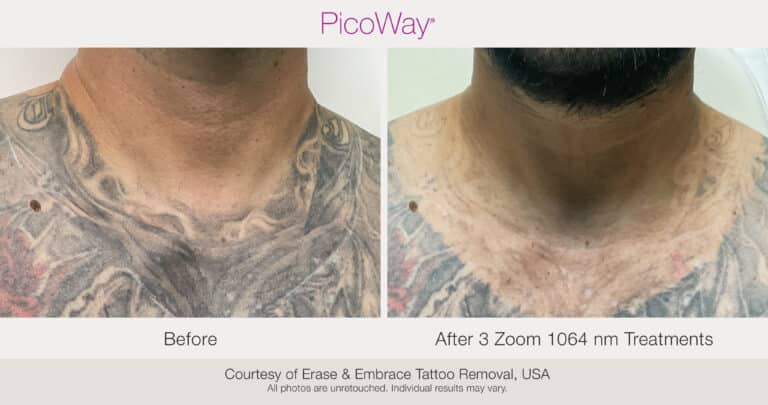 pico tattoo