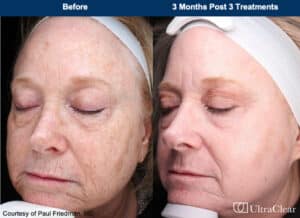 Ultraclear before and after photos