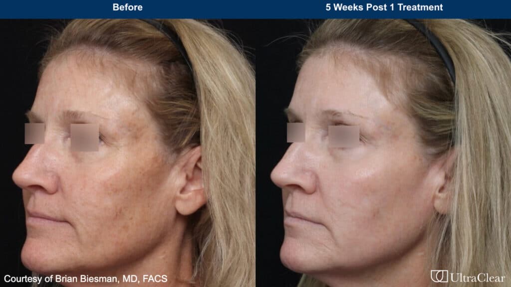 Ultraclear before and after photos