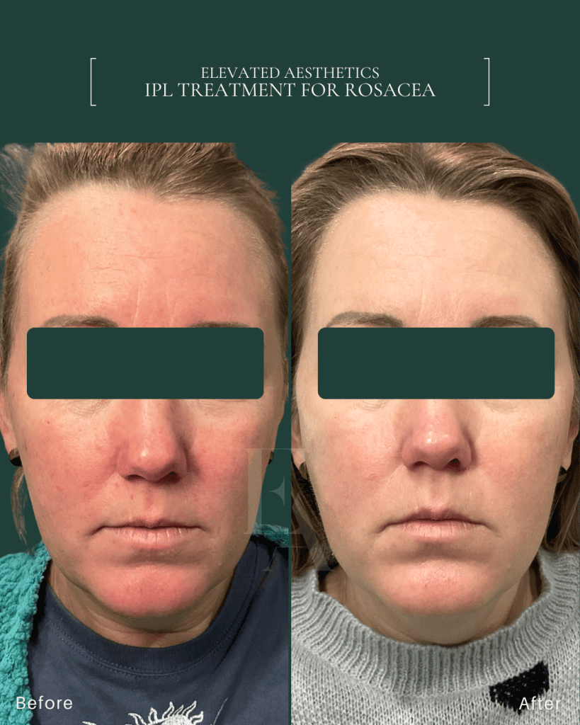 Elevated Aesthetics Rosacea Before and After