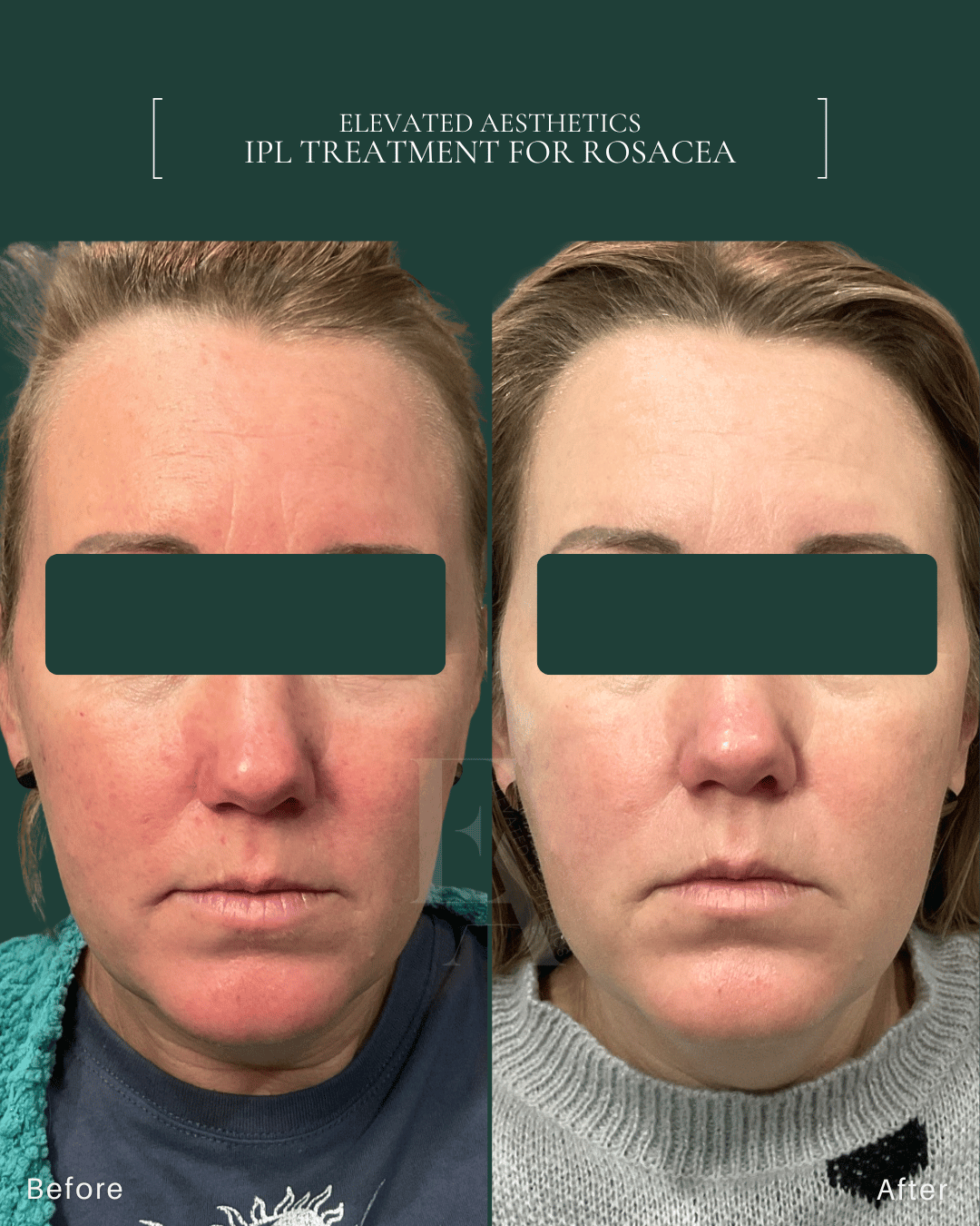 Elevated Aesthetics Rosacea Before and After