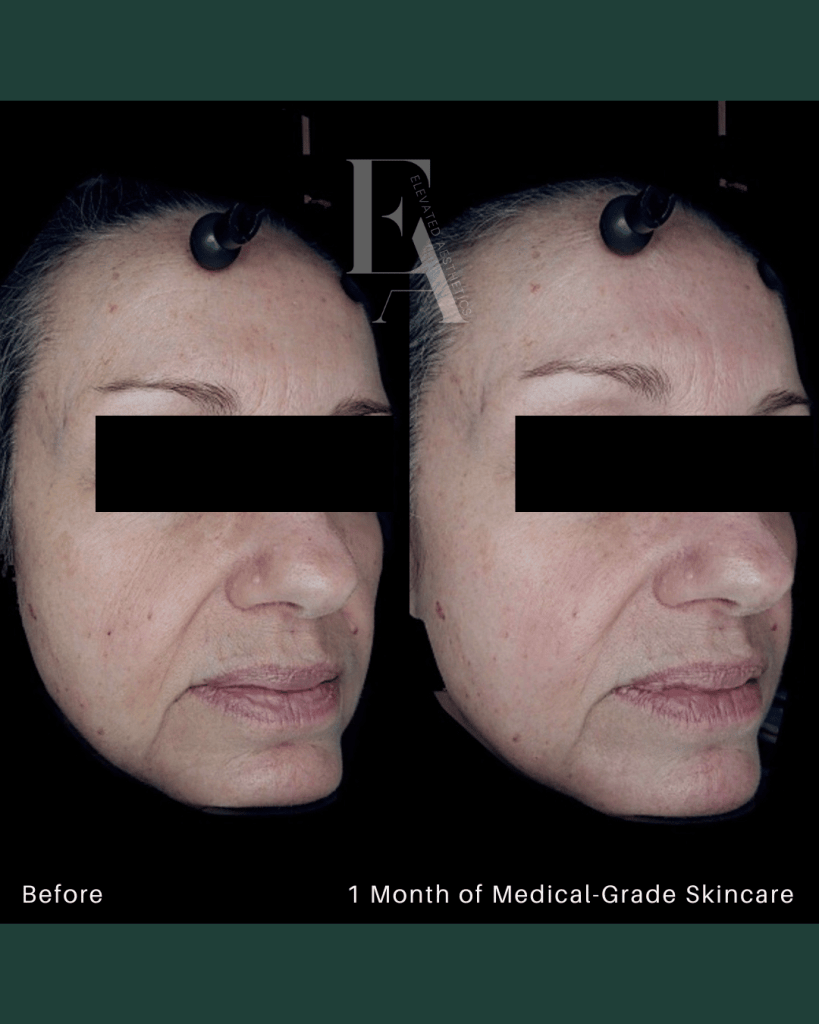 Elevated Aesthetics Medical Grade Skincare 1 month results