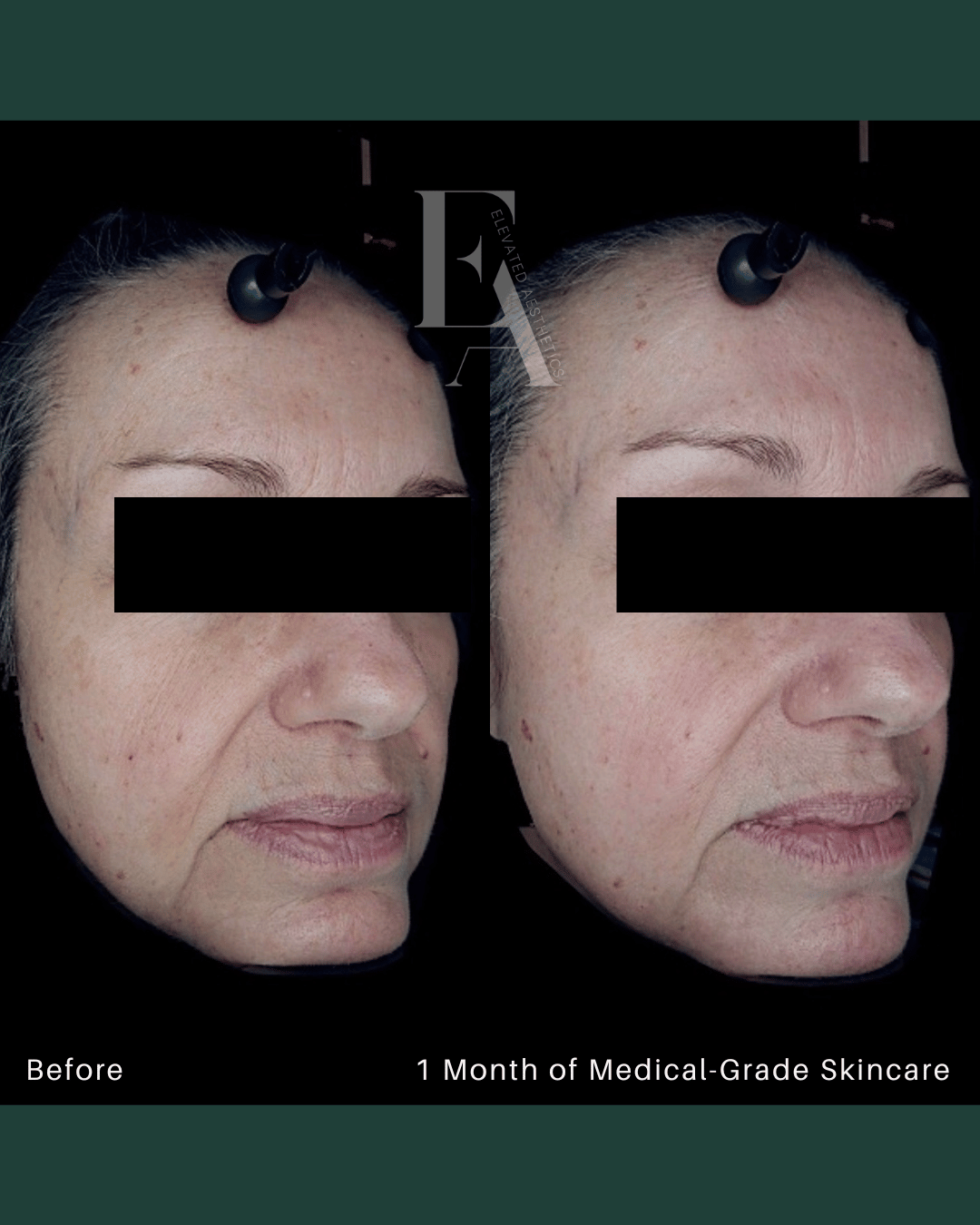 Elevated Aesthetics Medical Grade Skincare 1 month results