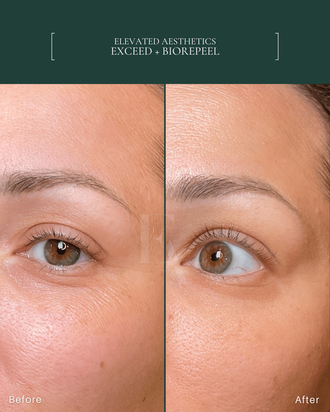 Elevated Aesthetics Exceed + BioRePeel