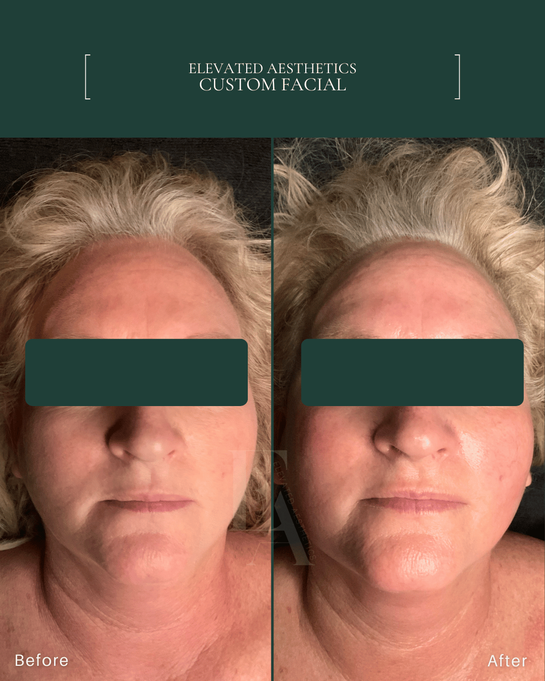 Elevated Aesthetics Custom Facial