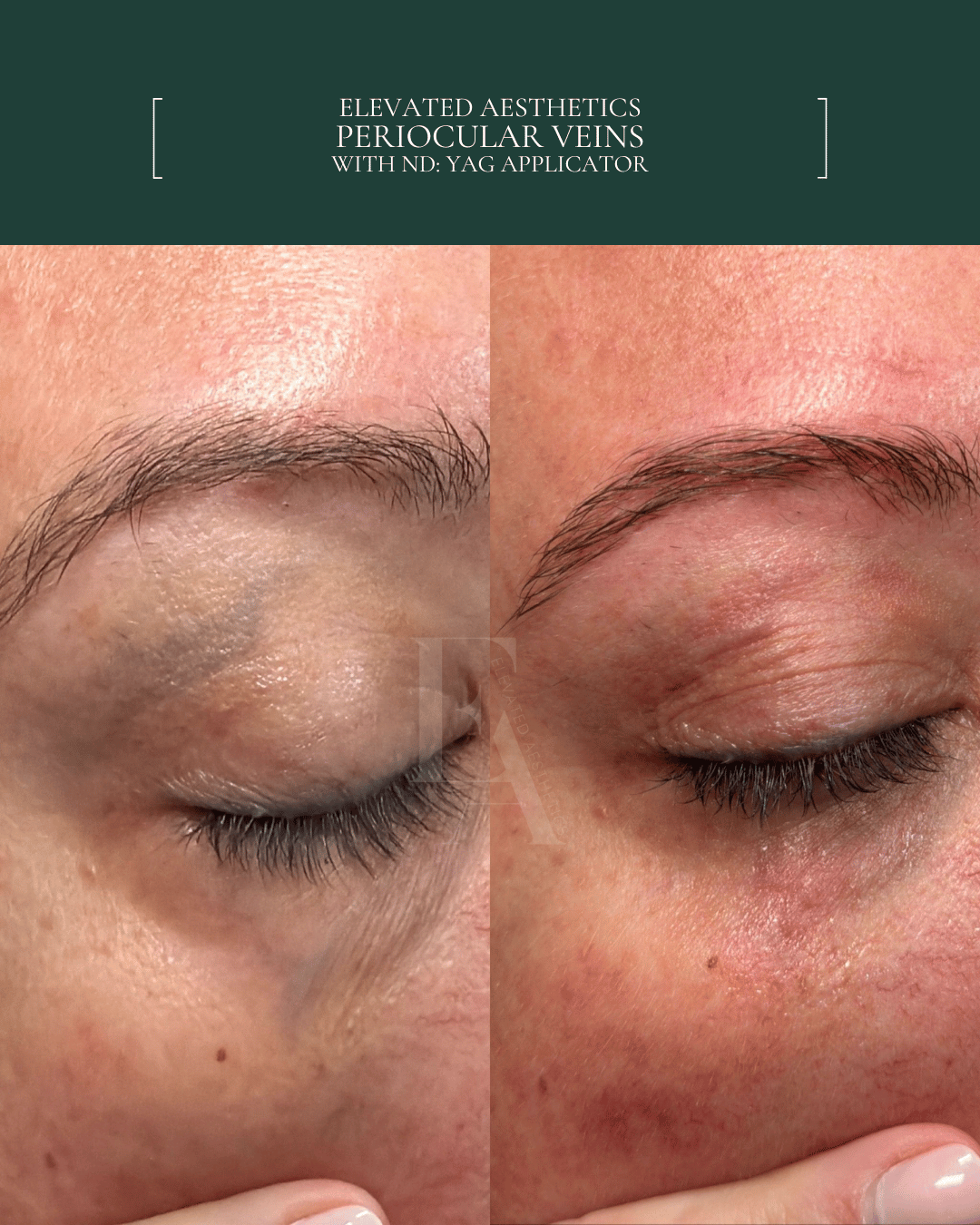 Elevated Aesthetics Periocular Veins